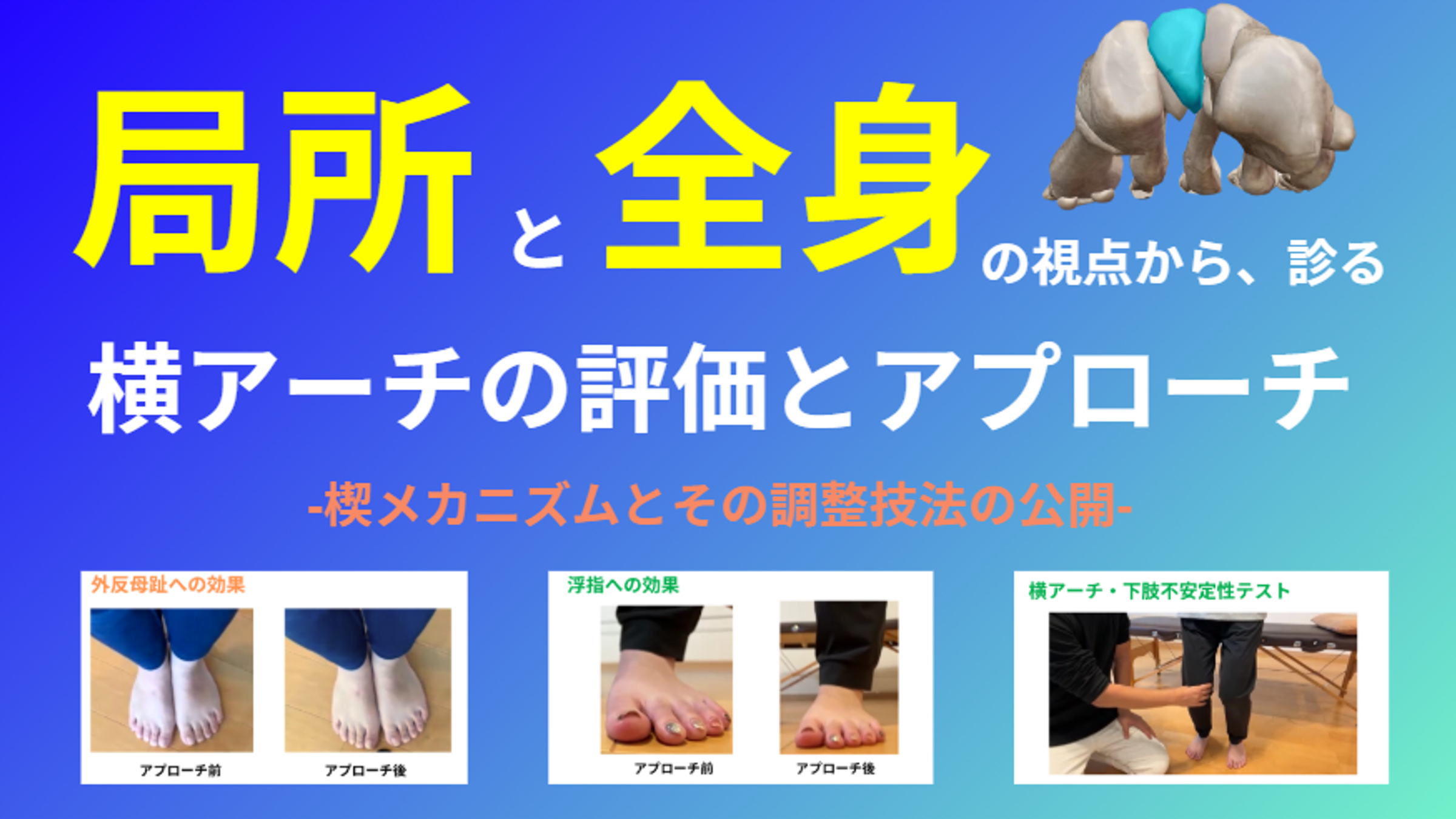 横アーチの評価とアプローチ